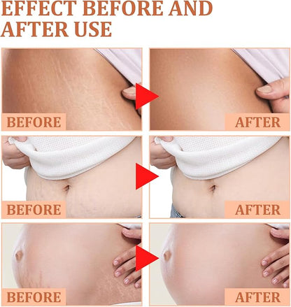 Eelhoe - Stretch Marks Removal Cream (Original)