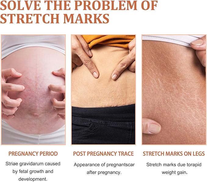 Eelhoe - Stretch Marks Removal Cream (Original)