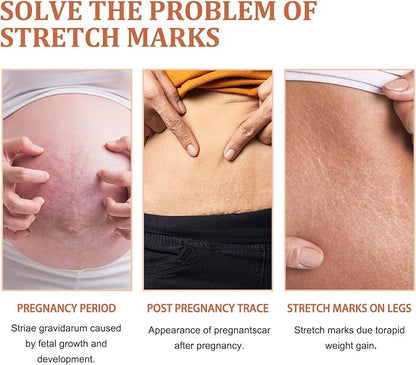 Eelhoe - Stretch Marks Removal Cream (Original)